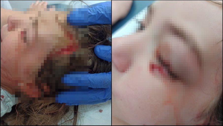 STRAVIČNI PRIZORI U PRIJEPOLJU: Pitbul izujedao djevojčicu, dijete hitno prebačeno u bolnicu