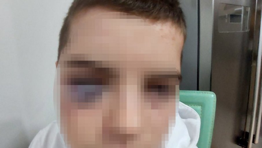 DJEČAKU OKO MODRO I ZATVORENO: Otac iz Surdulice prijavio da mu je dijete (15) žrtva vršnjačkog nasilja