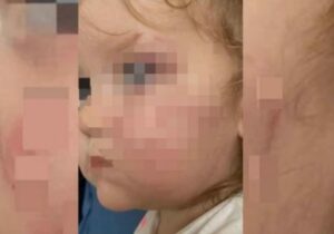 BROJNI PODLIVI: Vršnjak izujedao djevojčicu u vrtiću po licu i rukama