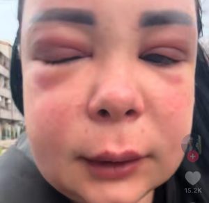 „КАЈЕМ СЕ, УНАКАЗИЛИ СУ МЕ“: Позната тиктокерка замало умрла након третмана ботоксом (ВИДЕО)