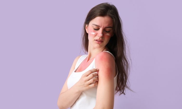 IZGORJELI STE NA JAKOM SUNCU? Evo šta treba da uradite da bi se koža oporavila