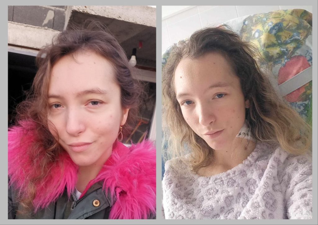 GODINA LIJEČENJA POSLIJE NOVOG BUBREGA: Djevojka iz Kneževa nakon transplantacije u Minsku imala komplikacija, konačno je bolje