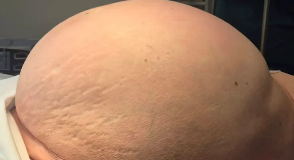 ŽENI ODSTRANJEN TUMOR OD 35 KILOGRAMA: Veliki uspjeh doktora Darka Milinovića i njegovog tima (FOTO)